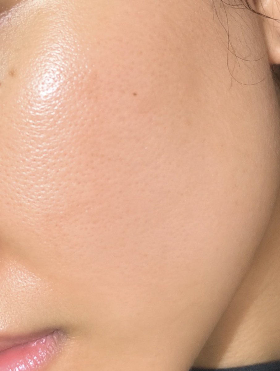 pistacigo's tweet photo. how "local skincare brand" did to my skin 😧🫶🏻 https://t.co/PJTVqrSAk8