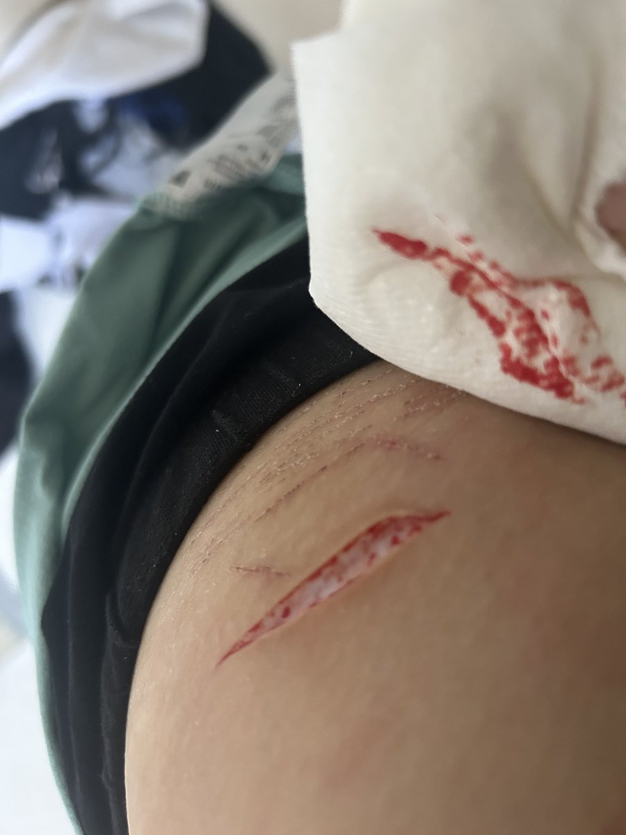 chiimsc's tweet photo. this is funny should I have gotten stitches too https://t.co/I4qsBU4gaq
