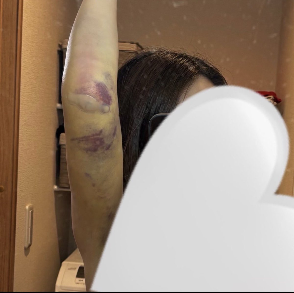 cnn__022's tweet photo. 二の腕脂肪吸引のダウンタイムまじえぐい、みんな舐めない方がいい‼️そしてやるなら絶対今の時期ねらって‼️

・圧迫着は真夏だと地獄
・秋冬だと内出血隠せる
・腕を胸より上に上げられない
・自転車の衝撃で腕がめちゃ痛い
・内出血1ヶ月くらい消えなかった
・ドライヤーも着替えもしんどい

写真撮っておいたんだけど
内出血の色と範囲が想像より凄まじくすごくてこれは夏に半袖で出歩けるやつじゃなかったwwww

「思ったよりダウンタイム楽でした」って
書いてる体験談、私には全く当てはまらなかったんですけど‼️笑
秋冬に手術��るのを本当におすすめしたい🥸