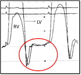 eodanielmd's tweet photo. 🫀 The "square root sign" (√) on cath:
• Sharp early-diastolic DIP in ventricular pressure
• Rapid rise to an elevated PLATEAU the rest of diastole
• 👉 to impaired ventricular filling
Ddx ➡️constrictive pericarditis or RCM

To tell apart ? Look for ventricular dependency https://t.co/hsllHlv8dH