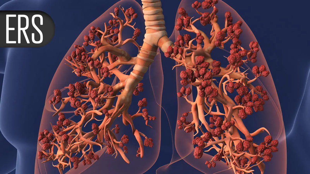 Aller_MD's tweet photo. Novel Two-#Prong #Biologic Shows Promise in #Asthma — Phase II study finds benefits with multi-targeting of inflammatory pathways. https://t.co/XRELI48gUc https://t.co/DQR7wgAMs9