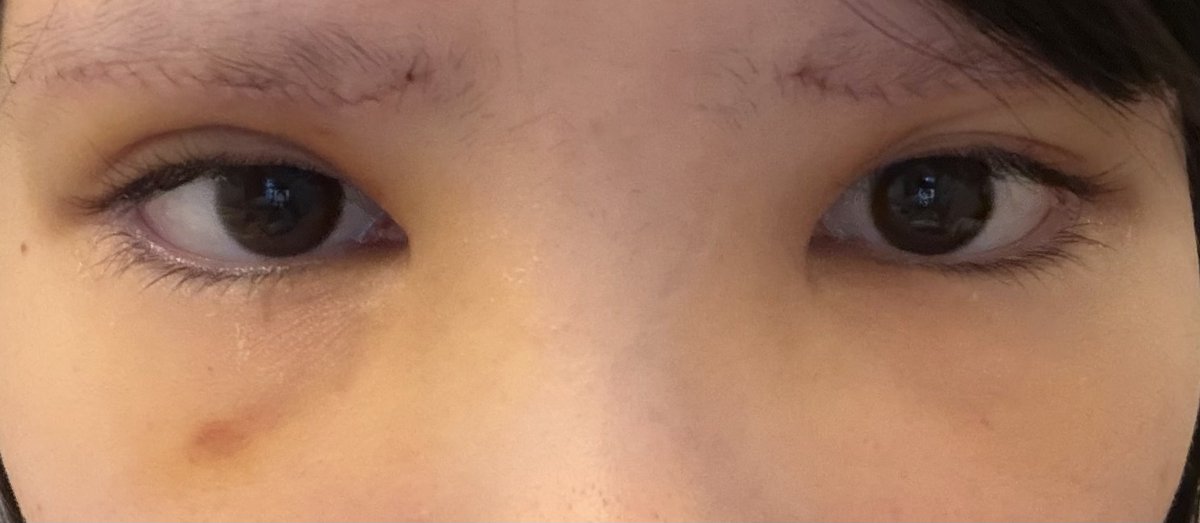 melolynun's tweet photo. 眉下切開 DT4日目

寝起きでも腫れはだいぶましになって代わりに内出血が出てきた 二重おかしいの治るかなー😓 https://t.co/frJuOT9J2M