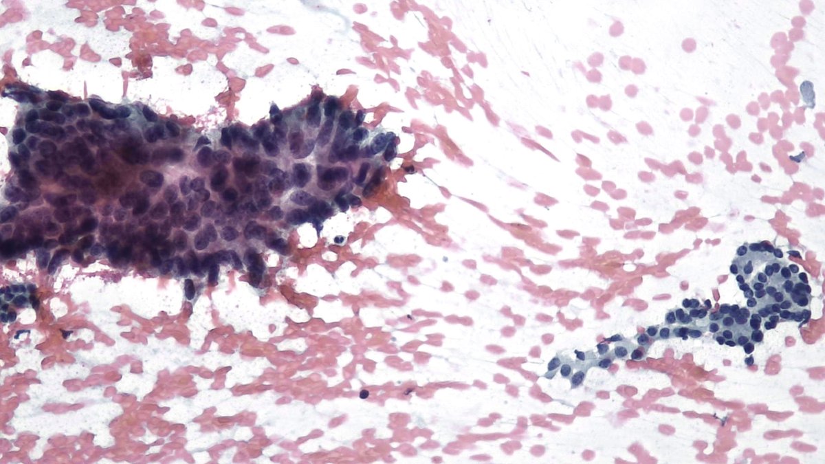 mdlozanoe's tweet photo. "Face to Face".  Just from the 🔬
Pancreatic FNA: tumor (PDAC) vs. normal ductal cells https://t.co/5em8qk9nBB