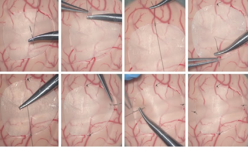 KangerMedical's tweet photo. 🧠 Reparación de la duramadre, diseñada teniendo en cuenta la biología.

Kanger Dura Patch: colágeno puro, biodegradable y reabsorbible, para cirugía craneal y espinal.

📩 crystal@kangeryl.com

#ReparaciónDural #Neurocirugía #DuraPatch https://t.co/MXo8AWTHfc