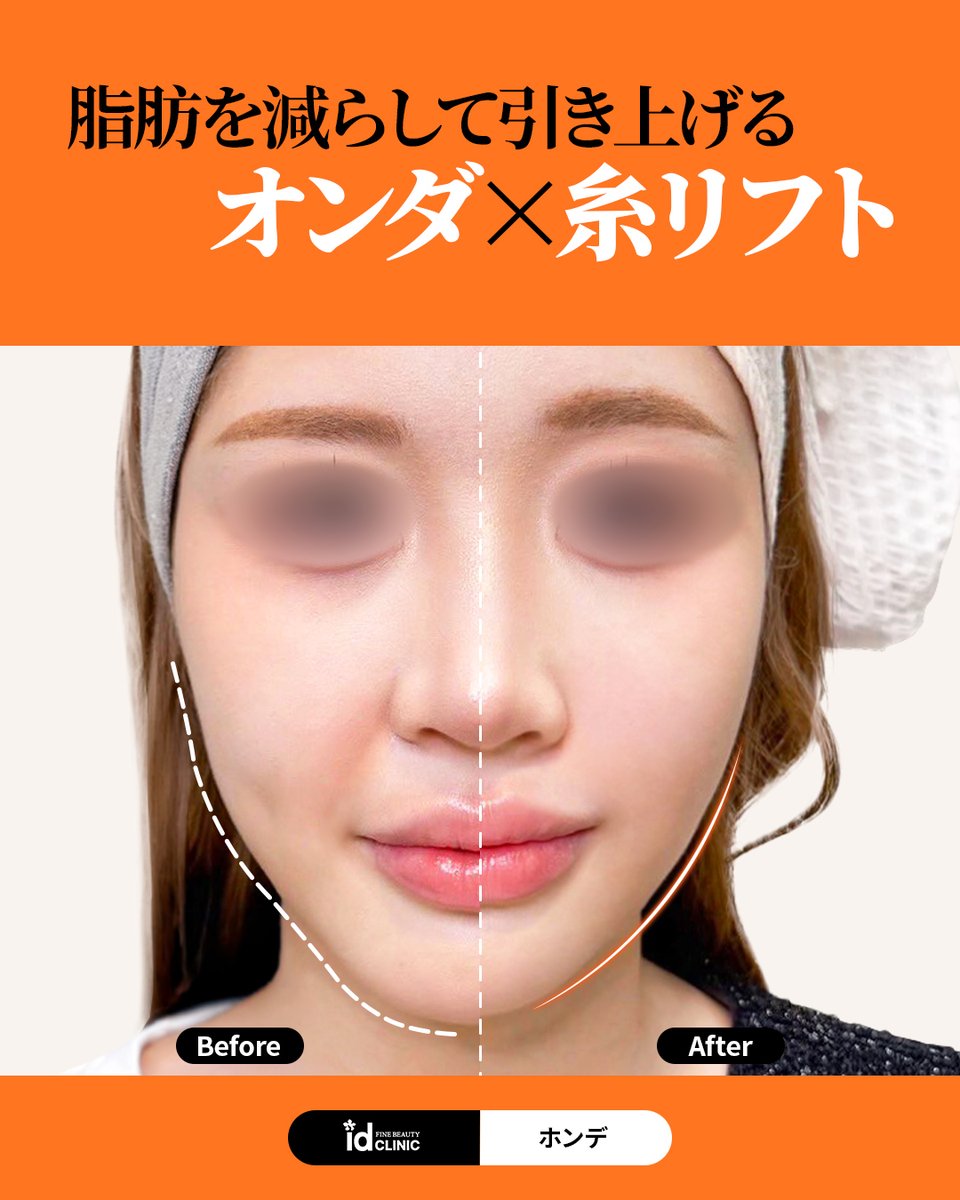 idclinicjp's tweet photo. 糸リフト+オンダリフト｜脂肪↓輪郭↑

🧡糸リフトならidClinic弘大🧡

✔ オンダでもたつきを減らして
✔ 糸リフトで引き上げる
✔ ２施術の組み合わせで維持力UＰ💗
✔ キレイなフェイスラインに

✨ 高層階で眺めの良い院内
✨ 日本語対応可

📍 id Clinic 弘大院
📞 ご予約・お問い合わせはこちら
https://t.co/vibZORBycc

＃オンダリフト #韓国美容 #糸リフト #弘大