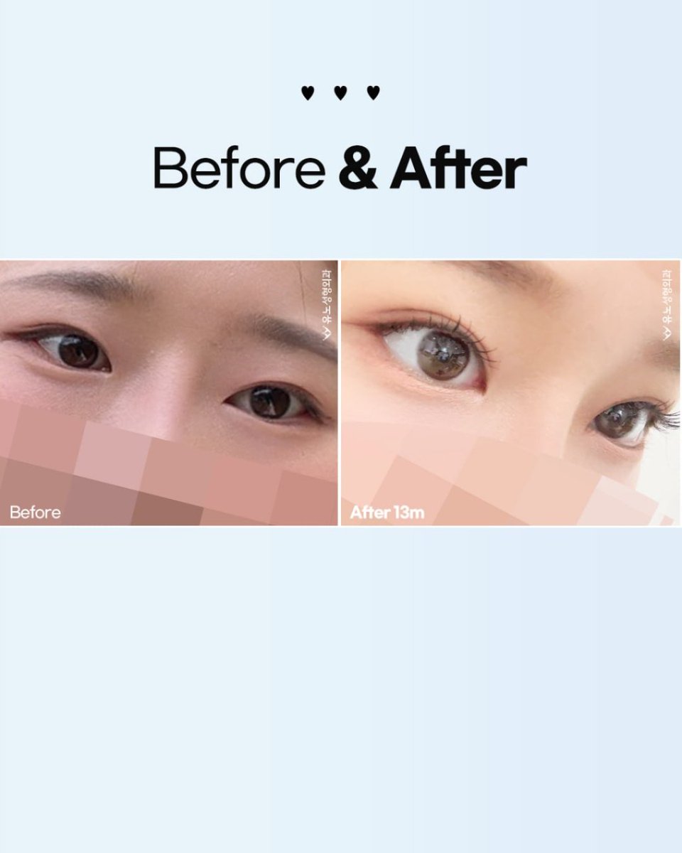 yuno_eng's tweet photo. ✨ YUNO Revision Eye Surgery ✨ 

For a more natural and harmonious result YUNO carefully analyzes your previous surgery and current eyelid condition 

📱 Contact Us
WhatsApp: +82 10 2257 8670
💬 KakaoTalk: yuno_ps

Only at YUNO Clinic
#YunoPlasticSurgery #RevisionEyeSurgery https://t.co/WGR0sLofdz