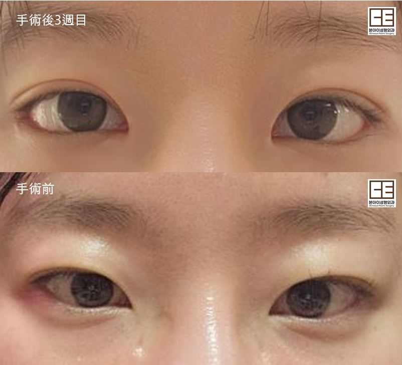 boneeyeps's tweet photo. ❤️ボナイ整形外科 目整形❤️
▶️切開 再手術 目頭切開再手術
▶️目尻切開 タレ目形成

気になることございましたらいつでも
公式LINEにご連絡ください💌
https://t.co/VAtPXUYHF7

再手術も得意とする病院です！！
ボナイ整形外科で大変🫶🏻

#韓国　#整形 #ボナイ整形外科 #切開 #二重  #再手術
#目整形 https://t.co/YcxOBuTaA9