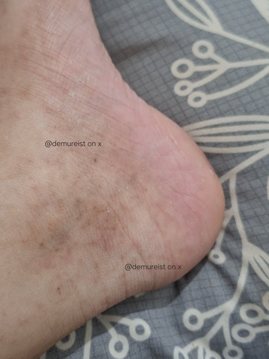 demureist's tweet photo. musim kemarau gini ketambahan pakai produk yang banyak fragrancenya beneran bikin eczema eksimku kambuh lagi😫

​padahal udah konsul klinik 2x tapi masih gatel bgt. akhirnya coba Biotalk Oat Ceramide Lotion ini! save duluu nanti aku bakal update review pemakaian D3 dan D7☝️‼️ https://t.co/nO6IddL6Q7