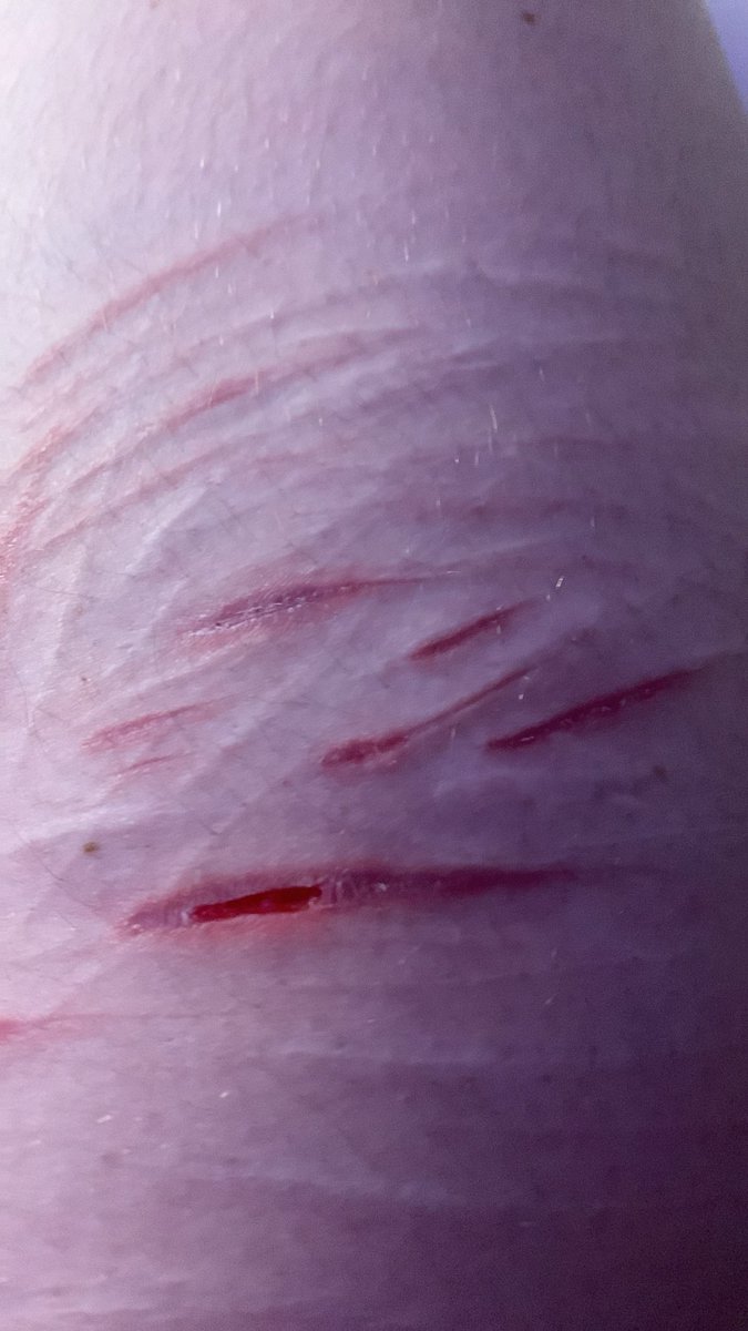 toothlessouk's tweet photo. old ask scar WONT HEAL ON THIS ONE SPOT https://t.co/EJ3SkN7Pov