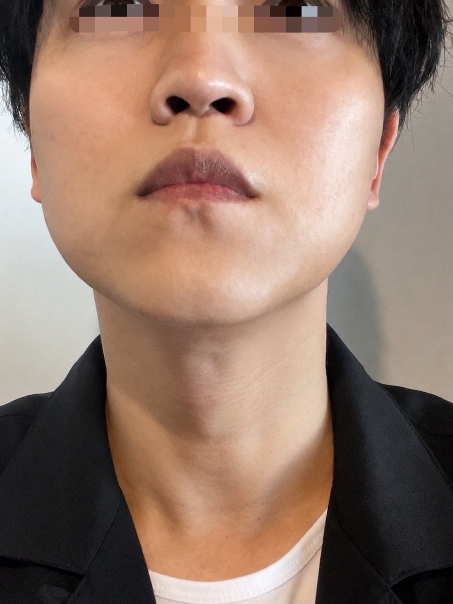 DotPTQuest's tweet photo. 前後比較試験

←preが
post→
#ヒゲ脱毛　#メンズ脱毛　#湘南美容 https://t.co/A5I7n7GHnp