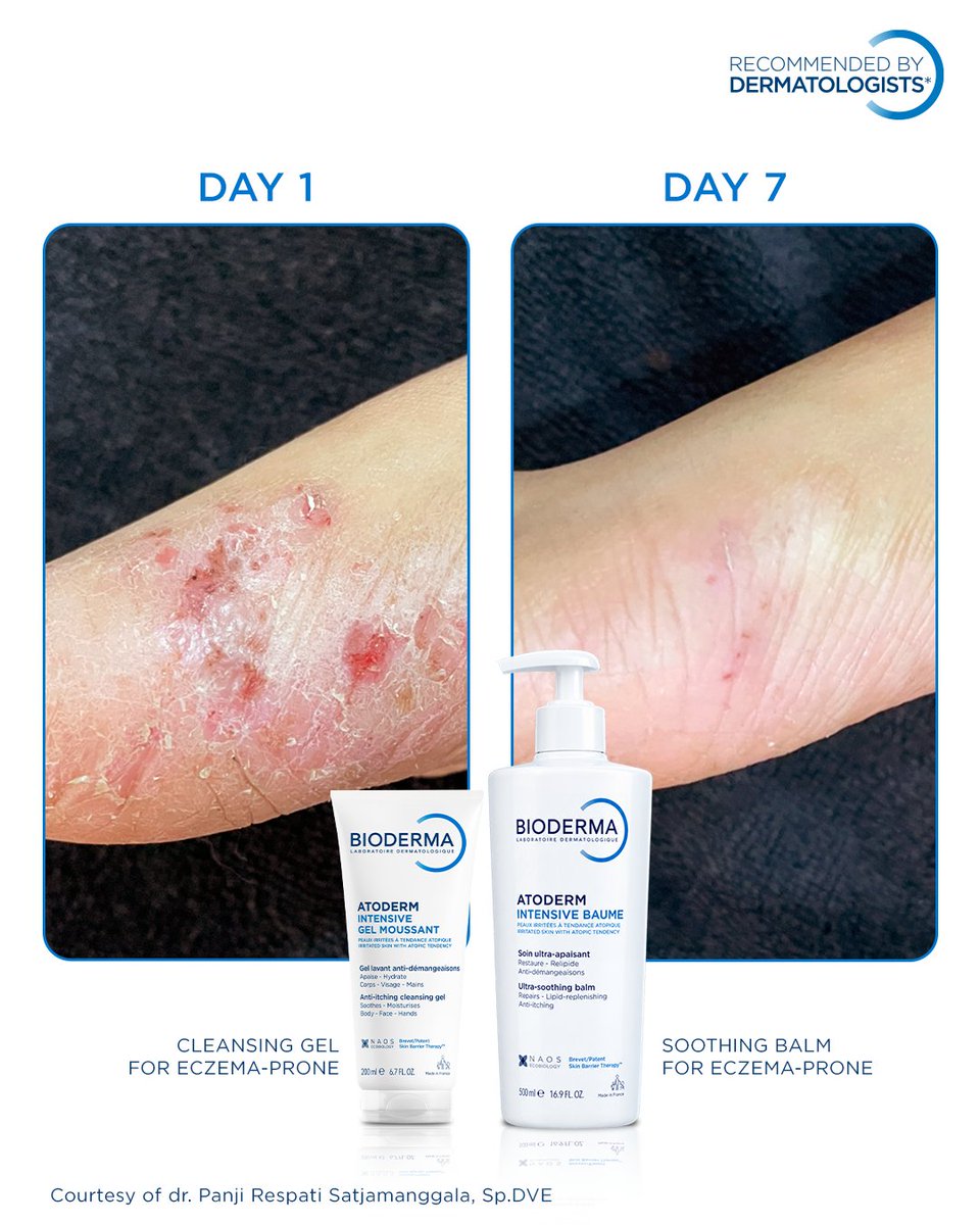 Bioderma_ID's tweet photo. Say goodbye to itching and severe dryness with the Bioderma Atoderm Intensive range, clinically proven to restore and protect eczema-prone skin. These real results could definitely tell!
 
Get yours now on Halodoc App!

#WorldEczemaDay #BiodermaIndonesia https://t.co/XJWbQfI82Z