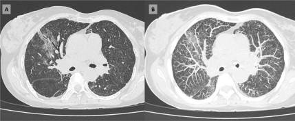 phlegmfighter's tweet photo. Latest post on Hickam's Victims, and basic diagnostic logic. #hickamsdictum #ockhamsrazor #PJP #histoplasmosis
https://t.co/KrOxKSIS95 https://t.co/PYZ6HoC4HK