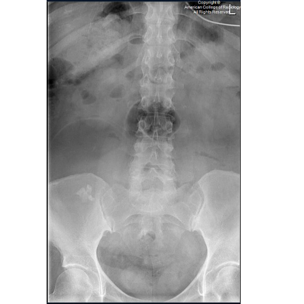 An X-ray image showing the abdominal region, including the spine, pelvis, and lower ribs.