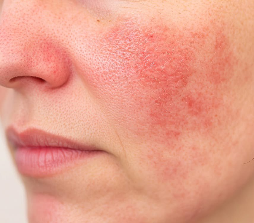 HealthyAlfred's tweet photo. 97.2% of rosacea patients cleared when they killed a stomach bacteria.

H. pylori. it's not a skin problem.

they didn't touch the face. they killed the bacteria and the skin cleared.

mastic gum kills H. pylori. all seven strains, including the antibiotic-resistant ones.

you've been buying creams for something living in your stomach.

everything's below. the studies, the limits, the brand ↓