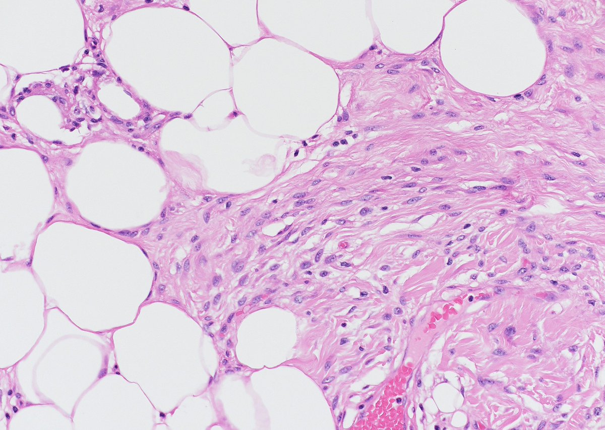 MBBS_Pathology's tweet photo. Happy Friday 💚
Lovely example of a spindle cell #lipoma
Spot the bland spindle cells, the ropey collagen and the interspersed islands of mature adipocytes.
CD34+
#pathology https://t.co/HX0YJTr80i