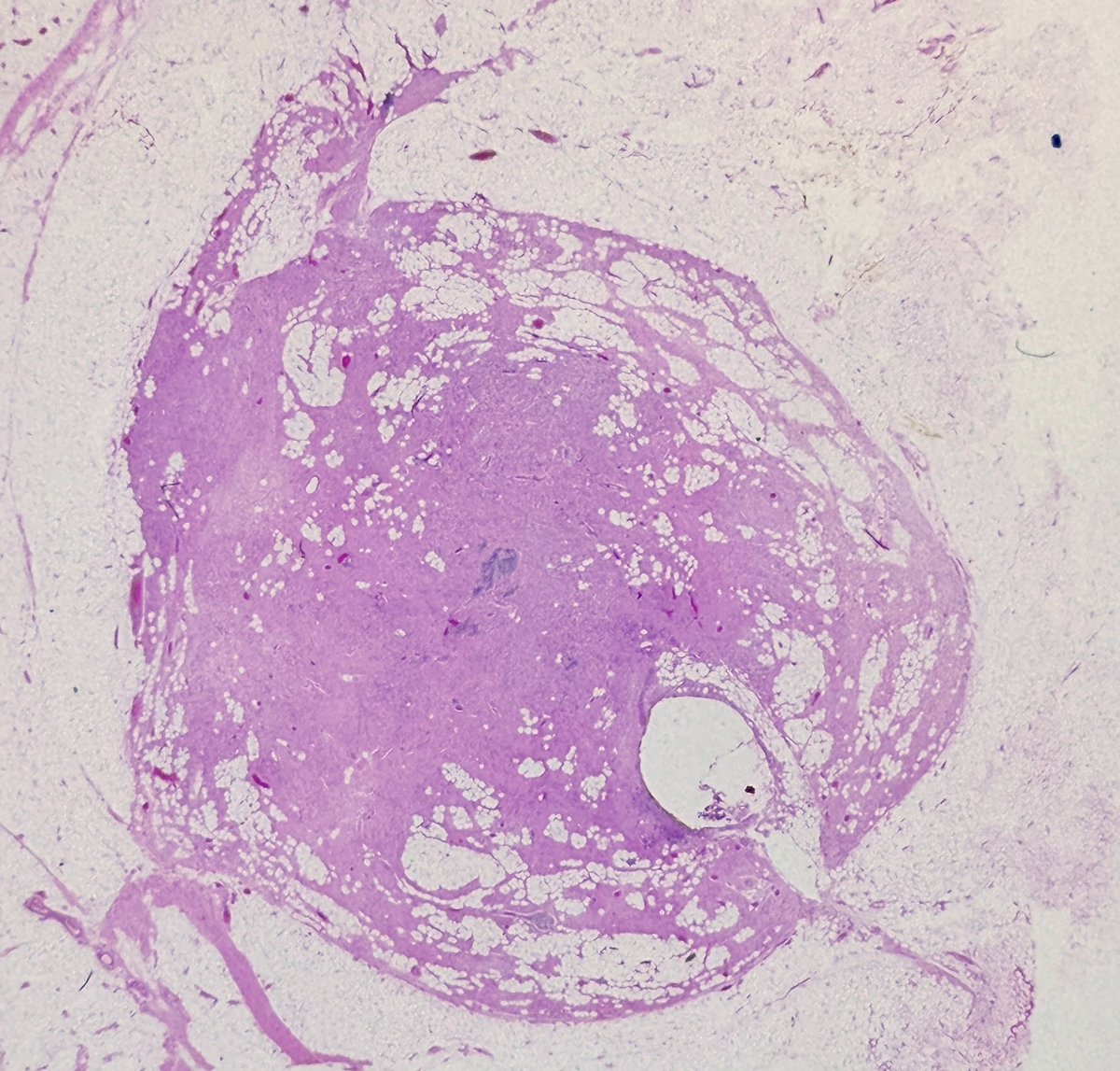 MBBS_Pathology's tweet photo. Happy Friday 💚
Lovely example of a spindle cell #lipoma
Spot the bland spindle cells, the ropey collagen and the interspersed islands of mature adipocytes.
CD34+
#pathology https://t.co/HX0YJTr80i
