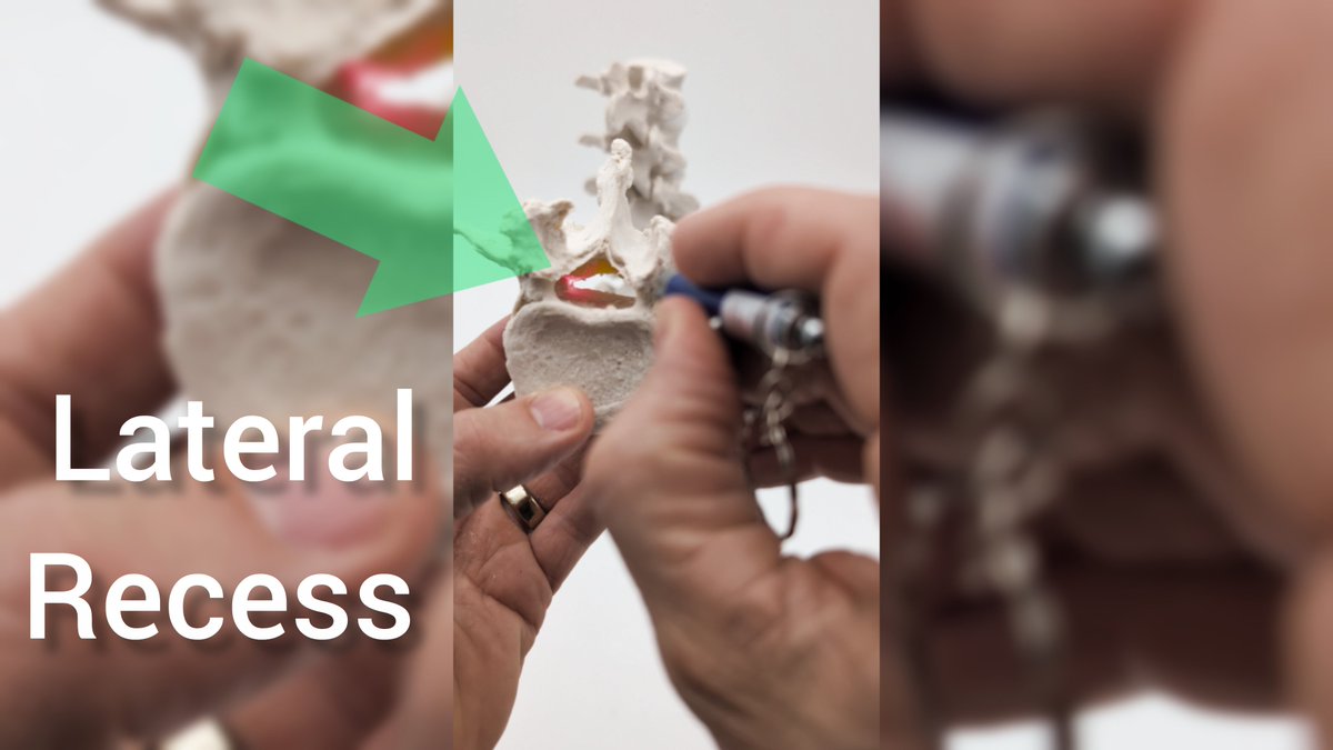 dynamicdisc's tweet photo. Learn the lateral recess
 https://t.co/E8e1HU7WOT https://t.co/XKungKzFHN