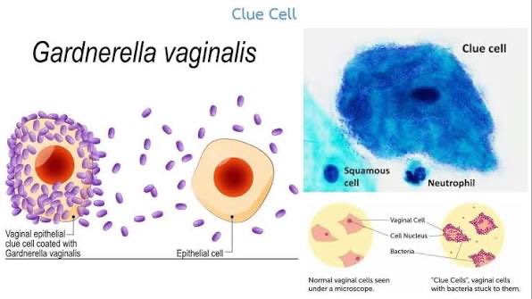 laboratorykh's tweet photo. ⭐ معلومة مهمة لاختبار الهيئة SLLE:
صورة الـ Clue cell من الصور المجهرية التي تتكرر في أسئلة اختبار الهيئة، لذلك احفظ شكلها جيدًا

هل سبق وشاهدت خلية تبدو حدودها غير واضحة وكأنها مغطاة بطبقة من البكتيريا؟ 👀

هذه تُعرف باسم Clue cell، وهي خلية حرشفية ظهارية (Squamous epithelial cell) تغطي سطحها أعداد كبيرة من البكتيريا، فتُعطيها مظهرًا حبيبيًا وخشنًا وغير منتظم.

🦠 تُعد الـ Clue cells من العلامات المجهرية المرتبطة بـ Bacterial Vaginosis (BV)، وغالبًا ما ترتبط بوجود Gardnerella vaginalis ضمن الفلورا المختلطة المسببة لـ BV

📚 Reference:
Urinalysis and Body Fluids – 5th Edition
Susan King Strasinger & Marjorie Schaub Di Lorenzo

#مختبرات_طبيه