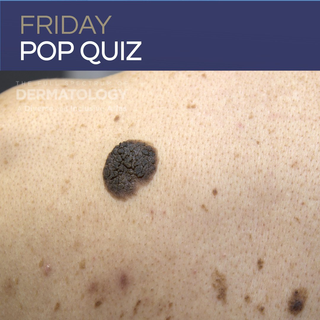 DermInReview's tweet photo. It’s Friday—time to test your board prep! A new Friday Pop Quiz is live on Next Steps in Derm. Can you guess the correct answer?

👇 Drop your guess in the comments, then tap the link to see if you got it right and review the explanations!

🔗 https://t.co/S4yZCGGiVw https://t.co/OFsza5Lo7N