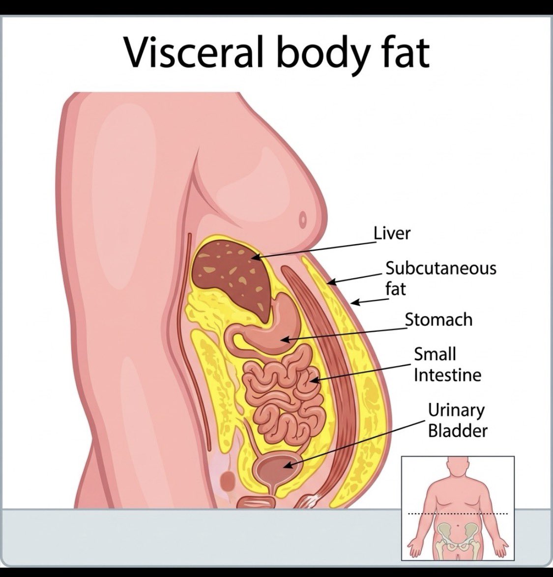 iremomore's tweet photo. Visceral fat is the hidden, dangerous fat wrapping around your internal organs like your liver and stomach. Unlike the soft fat you can pinch on your belly, you can’t see visceral fat which means even slim or skinny fat people can carry dangerous levels of it without knowing. Left unchecked, it quietly raises your risk for heart disease, type 2 diabetes, and high blood pressure.

The good news? Visceral fat is the first type of fat your body loses when you use the right approach.

Send me a DM today, and let's get rid of it for good.