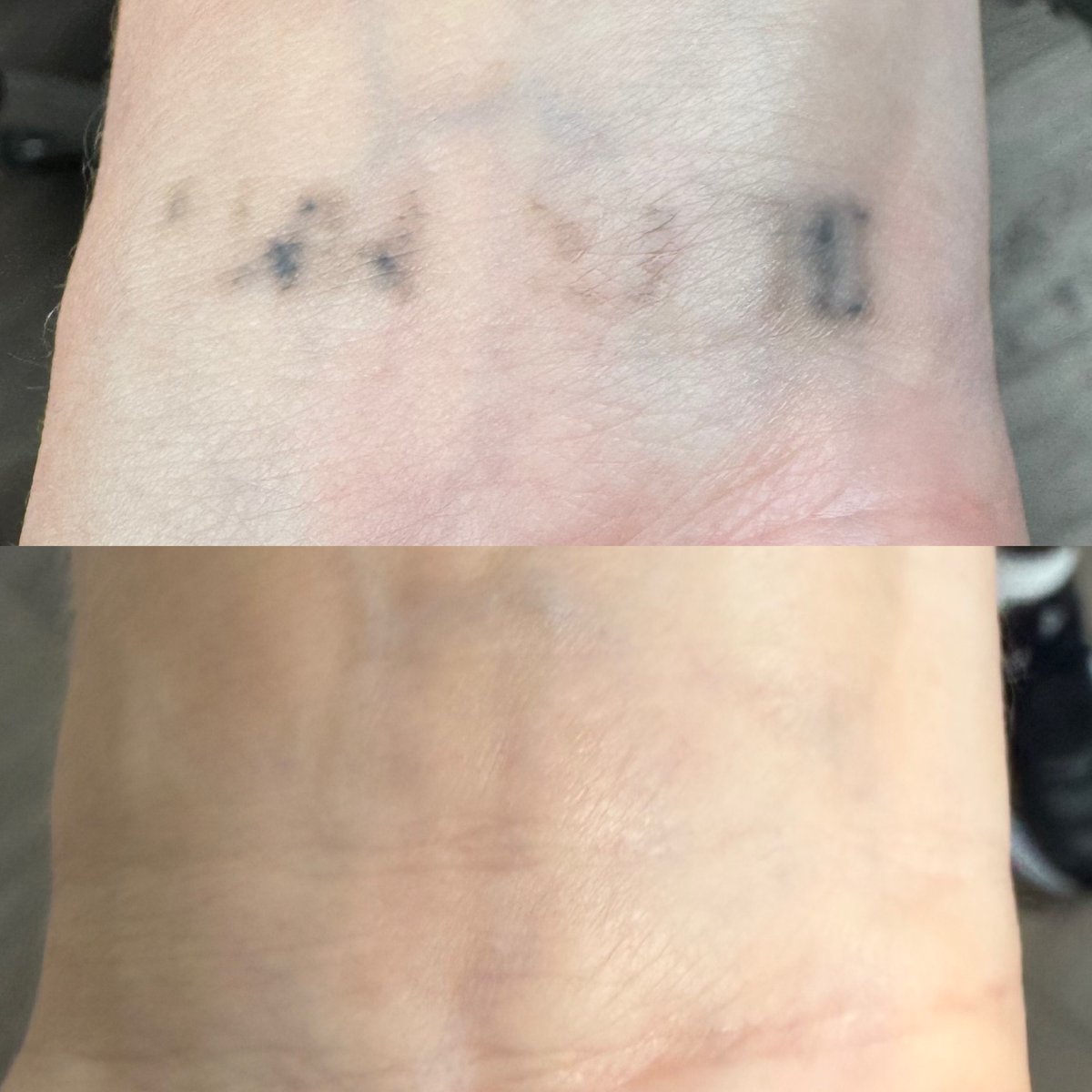 TT_LaserGrl's tweet photo. FOUR Treatments, FIVE Treatments somewhere else #makewisechoices #wisechoice #Denver #colorado #PicoSure #Picosurelaser #picosuretattooremoval #laser #lasertattooremoval #tattooremoval #tattoos #ink #fyp https://t.co/LYjA0zuHDi