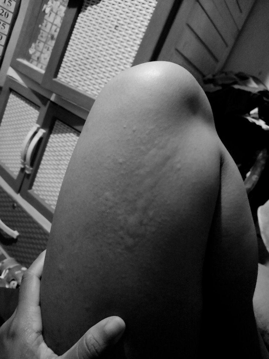 telulasss1's tweet photo. Biduran ini😖 https://t.co/n77UD5JJeV