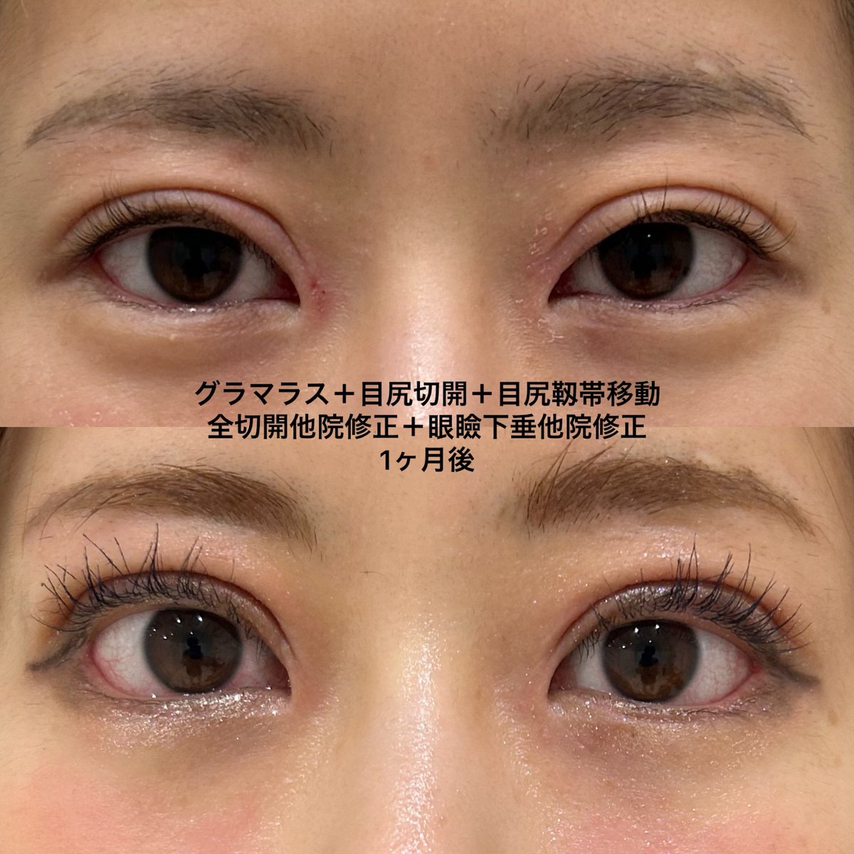eternalprince08's tweet photo. 二重切開・眼瞼下垂　他院修正（ハム目修正）

過去に二重切開、眼瞼下垂手術を受けられたものの睫毛の生え際が見えない二重になってしまった

睫毛の生え際がしっかり見える、開きのよい自然な二重をご希望で修正手術を行いました

#エターナルクリニック
#二重切開
#ハム目修正 https://t.co/TYqRBcM53n