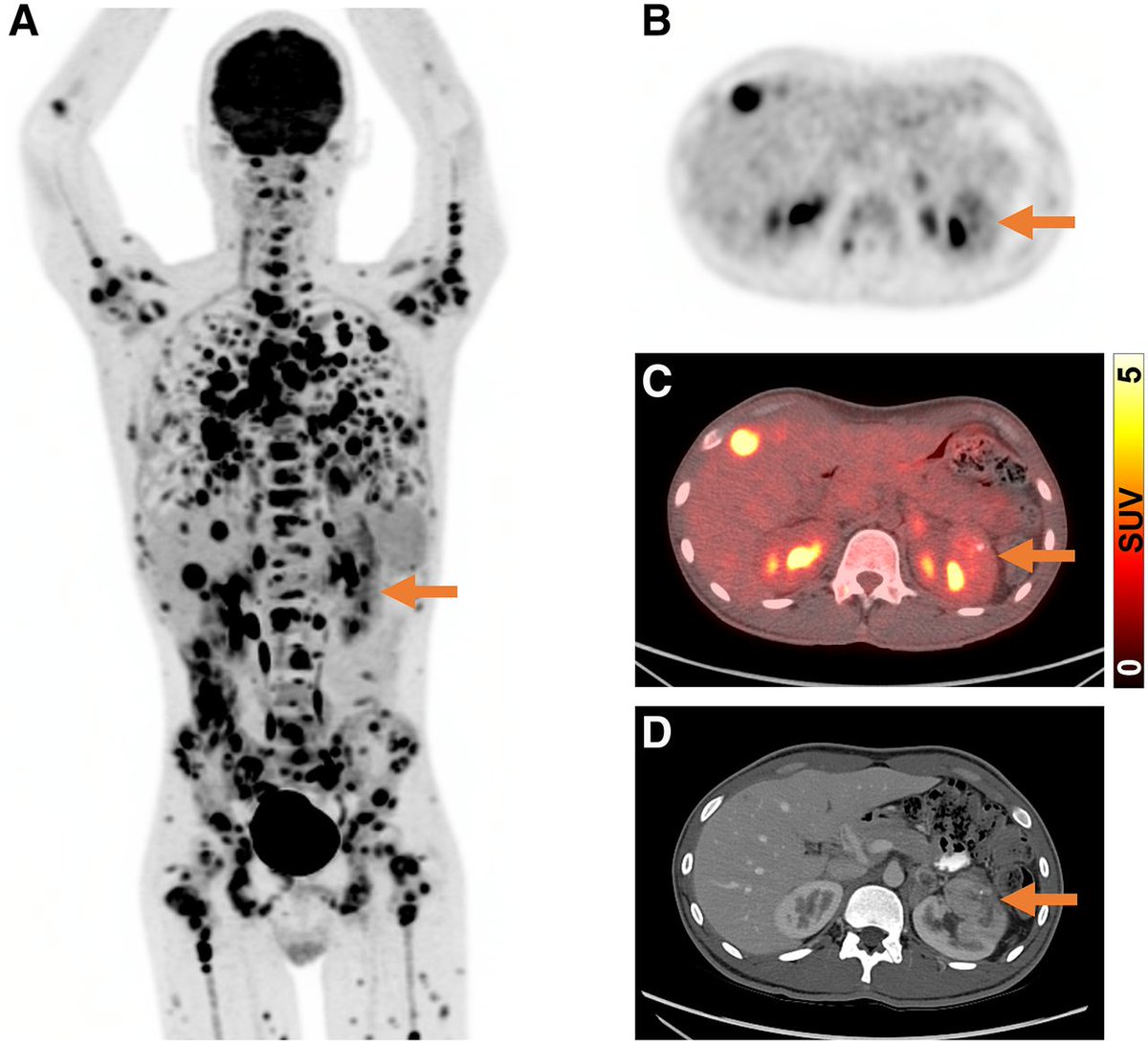 SNM_MI's tweet photo. A highly versatile nuclear medicine tracer has once again demonstrated how useful it truly is. In a new study published in JNM, 18F-FDG was found to be highly effective at diagnosing and staging renal medullary carcinoma. https://t.co/x3eS5N4ygl
