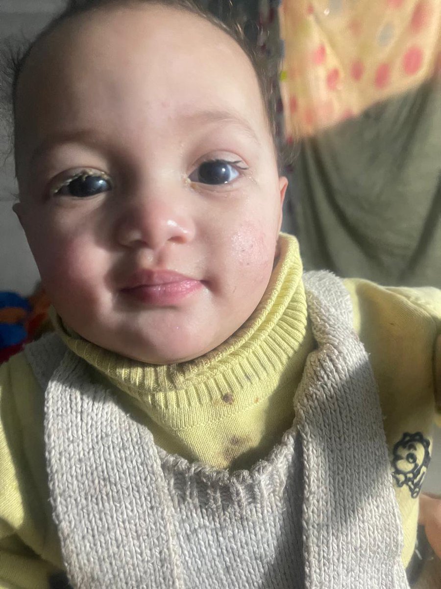 Maramnaswhan's tweet photo. https://t.co/QfsDMVvOuO
😭😭Iman is suffering from severe eye inflammation caused by rocket smoke and exposure to dangerous radiation. She urgently needs medication that I cannot afford. It breaks my heart to see her suffering while I’m unable to provide the treatment she needs.
@ainiladra @bintalshamsa @ireallyhateyou @Lowkey0nline