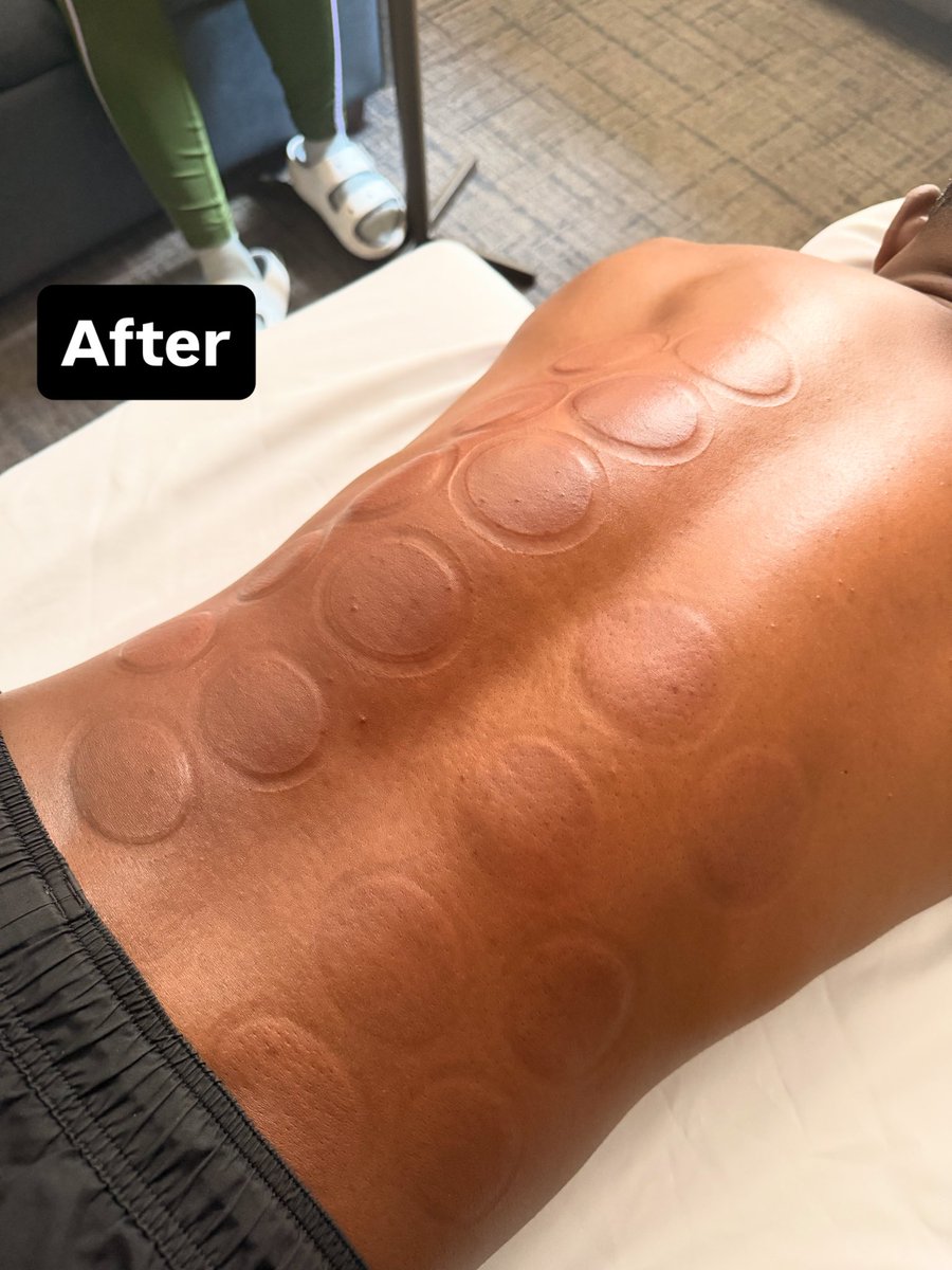RebeccaTalbot01's tweet photo. Difference in a session!

#RegisteredMassageTherapist
#MassageTherapy
#MassageTherapist #DeepTissueMassage
#SelfCare https://t.co/uHYsyzUYce