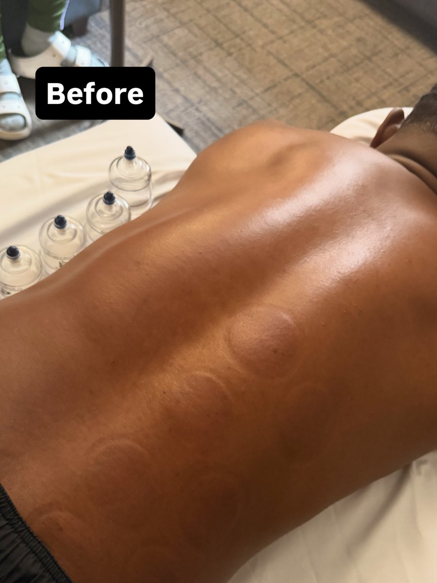RebeccaTalbot01's tweet photo. Difference in a session!

#RegisteredMassageTherapist
#MassageTherapy
#MassageTherapist #DeepTissueMassage
#SelfCare https://t.co/uHYsyzUYce