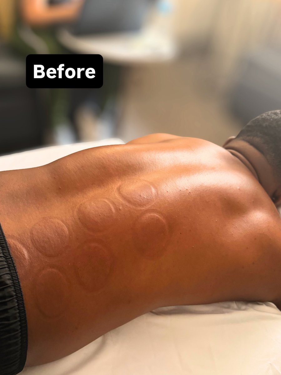 RebeccaTalbot01's tweet photo. Difference in a session!

#RegisteredMassageTherapist
#MassageTherapy
#MassageTherapist #DeepTissueMassage
#SelfCare https://t.co/uHYsyzUYce