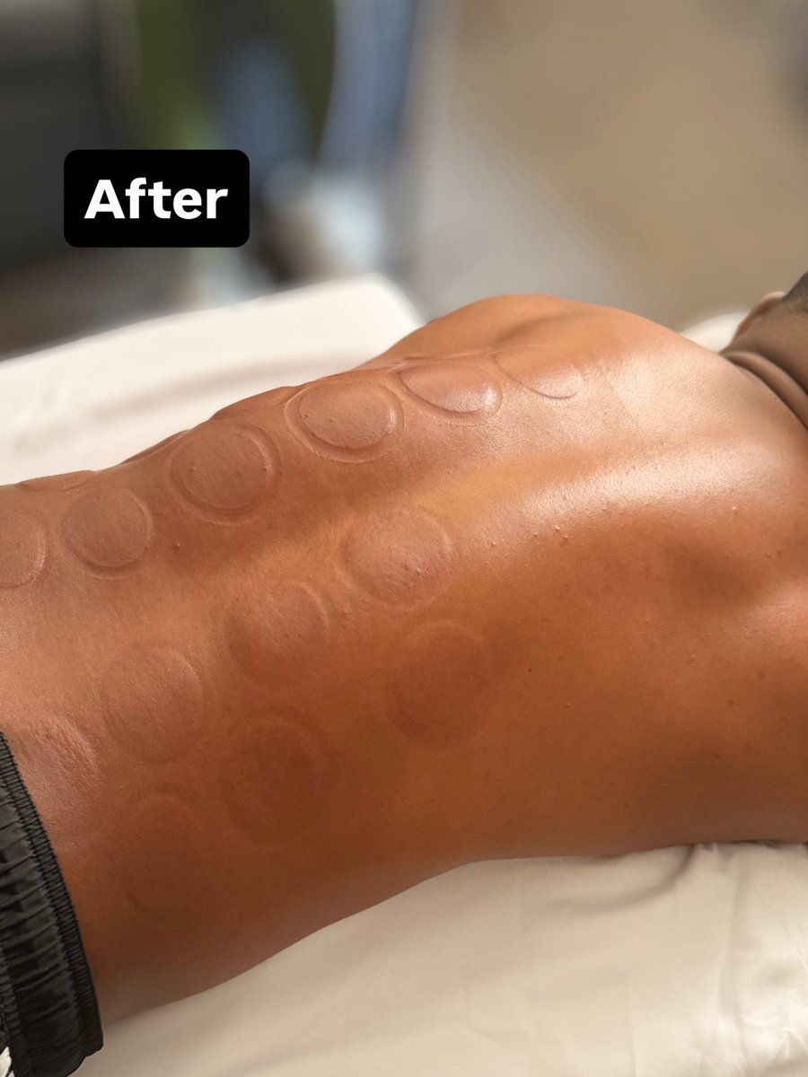 RebeccaTalbot01's tweet photo. Difference in a session!

#RegisteredMassageTherapist
#MassageTherapy
#MassageTherapist #DeepTissueMassage
#SelfCare https://t.co/uHYsyzUYce