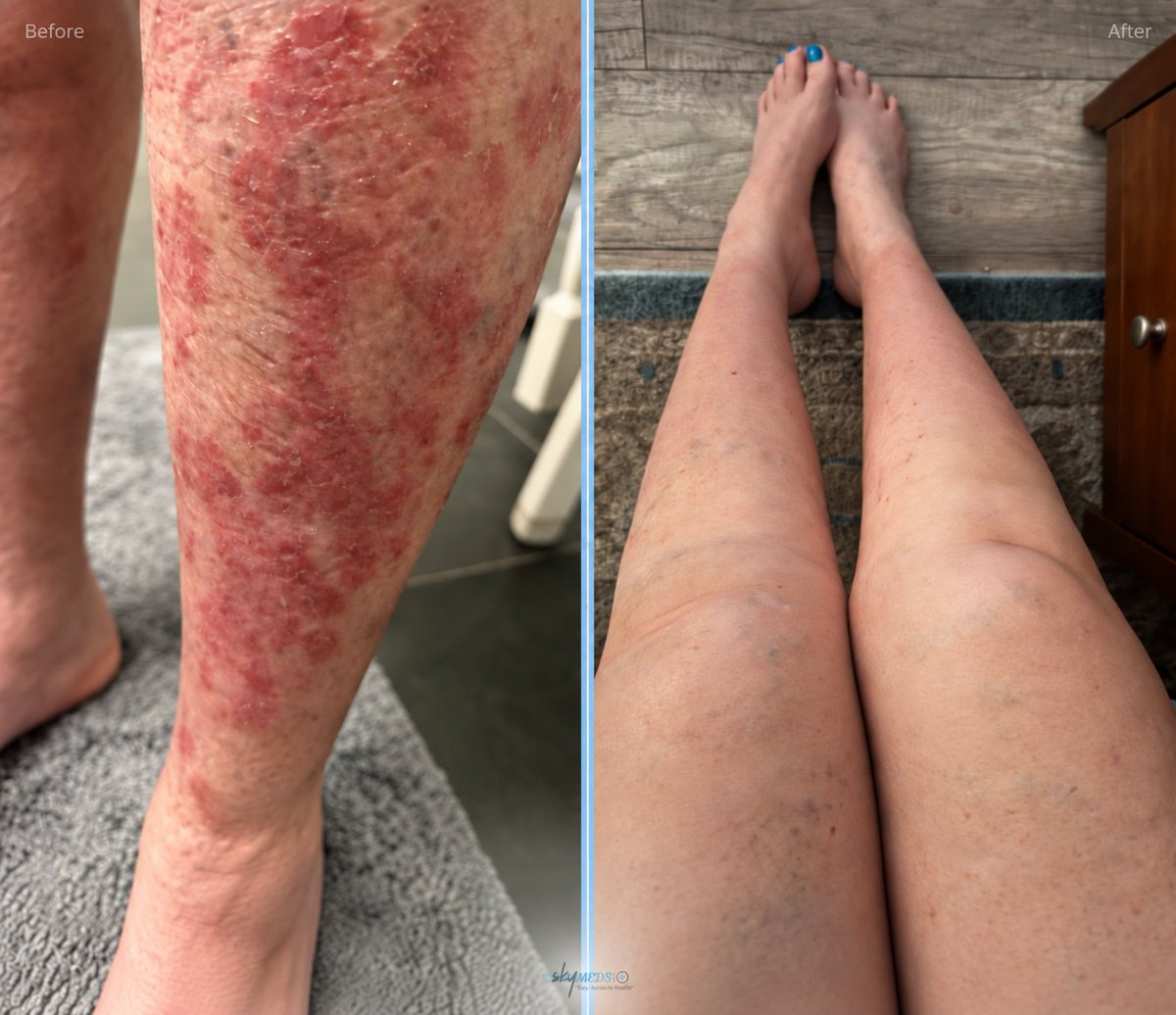 skymeds_store's tweet photo. She waited 6 months before saying anything. She wanted to be sure.

I've had psoriasis for over 30 years. I've taken every medication. Every biologic. The biologics gave me terrible side effects, and the cancer risk from them is very high.

Then I got breast cancer several years ago, and I went off all of it.

So I just lived with the psoriasis. Thirty years of it. I tried hundreds of holistic preparations. Almost every parasite cleanse and protocol out there. I have bottles sitting on my shelves that did nothing.

At my worst, I had 70% coverage. The only clear places were my head, scalp, face, neck, hands, and feet. Everything else my entire torso and legs was covered in red plaques. The cracking and bleeding had me in tears. The embarrassment is something only people who've had it understand.

And the scarring never goes away. You wait years for your skin to clear, it finally clears, and then joy gets cut off and down you go again.

I also had to fight permethrin-resistant scabies for several months. That was its own battle of perseverance. I couldn't say anything about any of this until that was resolved.

Finally. Over.

I did my own cleanse. Ivermectin 24 mg and Fenbendazole 444 mg, once a day for 30 days. And prayers on my knees.

That was in March. I've done no maintenance since.

I am 95% clear.

I talked about it for the first time on a feed last night. Six months of watching, waiting, making sure it held.

I give God all the glory for this. ❤️‍🩹🙌

👇 30 years. If you're still fighting yours, don't stop looking.

⚠️ Not medical advice one person's experience. Talk to your doctor.

#Psoriasis #Ivermectin #Fenbendazole #Healing