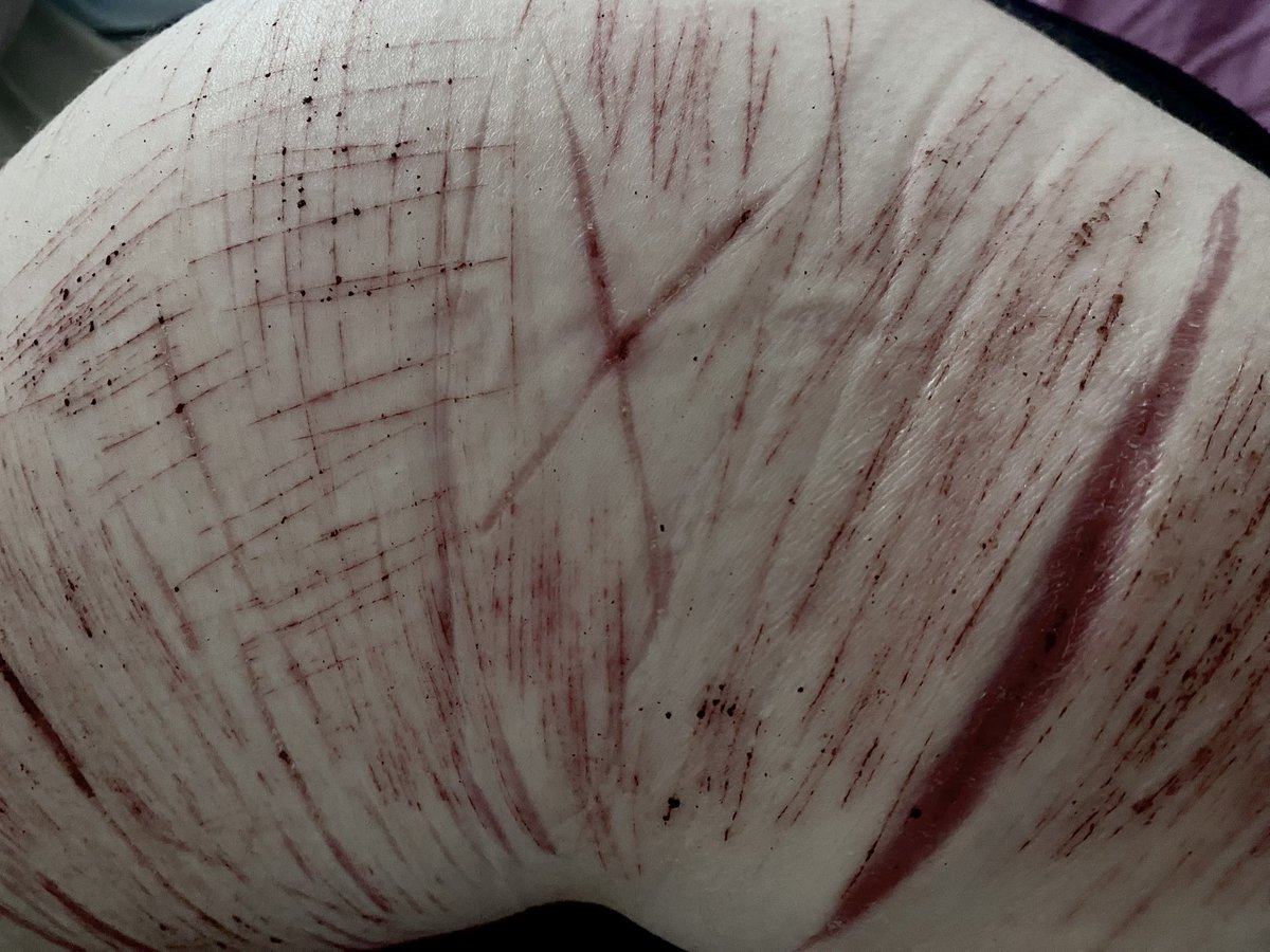 Mimixlj's tweet photo. My hip 8 months ago 
Sfx make up btw https://t.co/KGW7ztCv2M