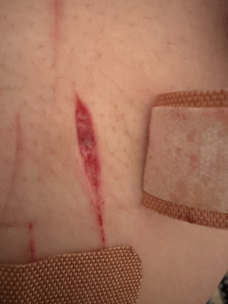 Exho22222's tweet photo. SFX MAKEUP ALL FAKE PRACTICE SFX MAKEUP
Bit my finger and the mark it left looks like a smiley face :) my cvts from last night are still open and not scabbed over yes, also I didn’t realize but I did hit beans on one of them but barely https://t.co/wRIqQ2qWaS