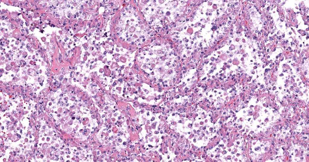 JMGardnerMD's tweet photo. 20 yo man with deep thigh mass. 
Answer ✅ https://t.co/ElSWoQiTKy 
Digital slides: https://t.co/UAgSoTCcer. 
#BSTpath #pathologists #pathology #pathTwitter https://t.co/bSTrZNIwMs