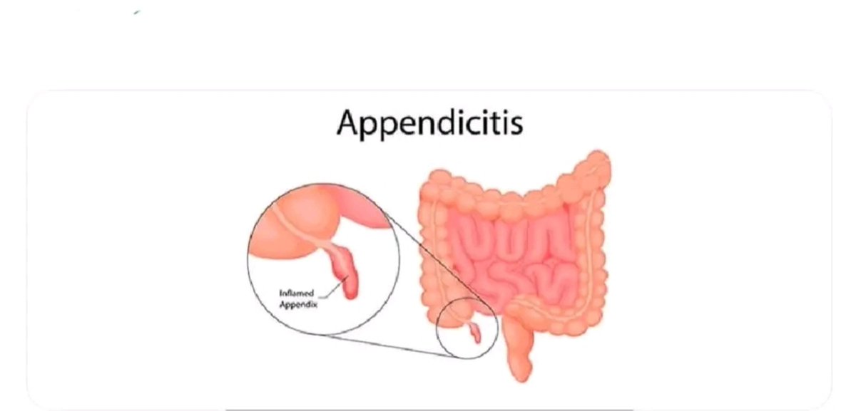 Vivekmadhvimuku's tweet photo. Ah yes, the #Appendix

proof that even your body keeps useless attachments."

#Parasite

@WHO https://t.co/XhKQ8THO22