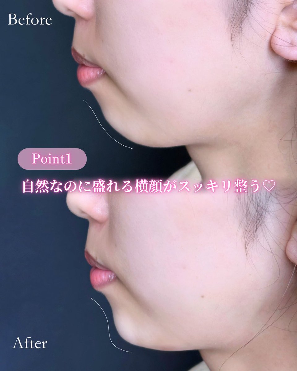 lula_tenjin's tweet photo. 顎ヒアルで横顔をすっきり美しく✨️

顎に自然な立体感をプラスすることで、フェイスラインが整い、バランスの良い印象に💭
「もう少し顎を出したい」「横顔を綺麗に見せたい」
という方にもおすすめです🙂‍↕️
  #ルラ美容クリニック  #ルラ美容クリニック福岡天神院  #顎ヒアルロン酸 https://t.co/fmaA5Oz9Ai
