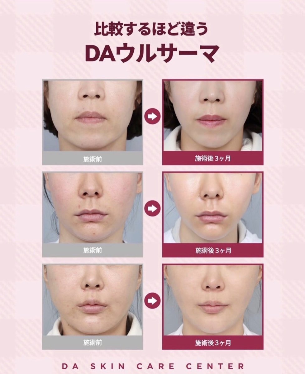 da_skin_jp's tweet photo. ❤️DAウルサーマ❤️

ウルセラ+サーマジの同時施術で、ドラマチックな効果が✨🫶🏻

✔️ウルセラは、お肌の奥深くから引き上げる超音波リフティング💗
✔️サーマジは、高周波リフティングでお肌の奥深くからハリとシワを改善できます💕

確実な効果が得られたい方は是非！
プレミアムリフティング施術のウルサーマをお試しください💎

是非DAプチセンターでお試しください❣️
DA プチセンター公式ラインからご予約いただけます🤍

♥お問い合わせは♥
💚LINE : https://t.co/6saMUjuyTj