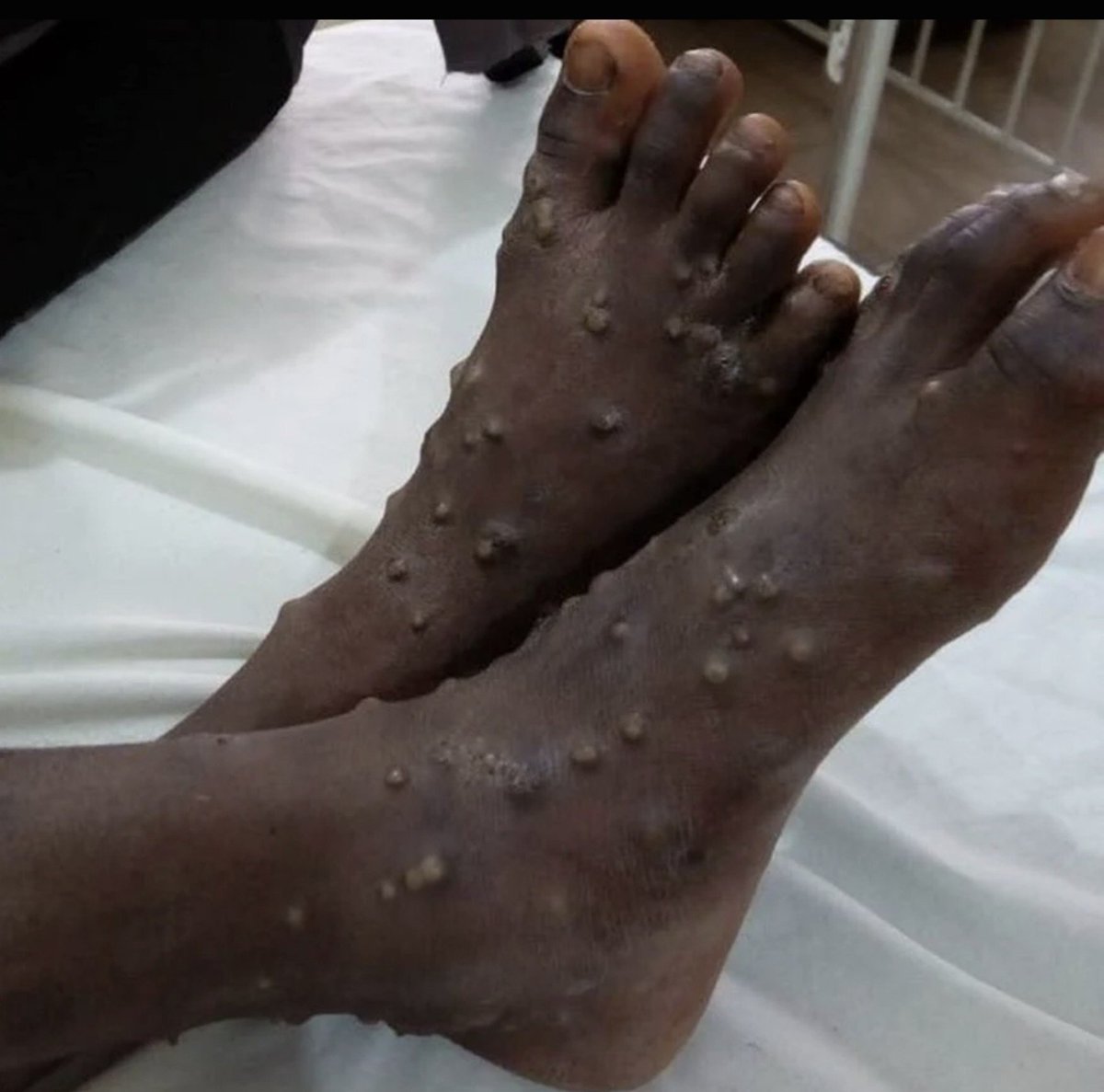 Escalet83's tweet photo. Variole du singe à #Ceuta :
⚠️ Un marocain détecté positif dans un camp de migrants à Ceuta.
On attend quoi pour tout péter ? 
On regarde le malheur s'installer chez nous, sans broncher et avec NOTRE argent.
#Remigration #STOP_immigration #Frexit https://t.co/DWCsbBuFzc