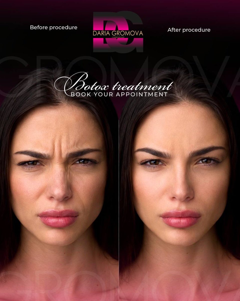 TequilaByan's tweet photo. FULL FACE BOTOX | Subtle refinement. Natural beauty. A full-face Botox treatment is designed to soften dynamic wrinkles, relax overactive muscles, and create a fresher, more rested appearance—without changing your natural facial expressions. https://t.co/vnfUbYmVFH