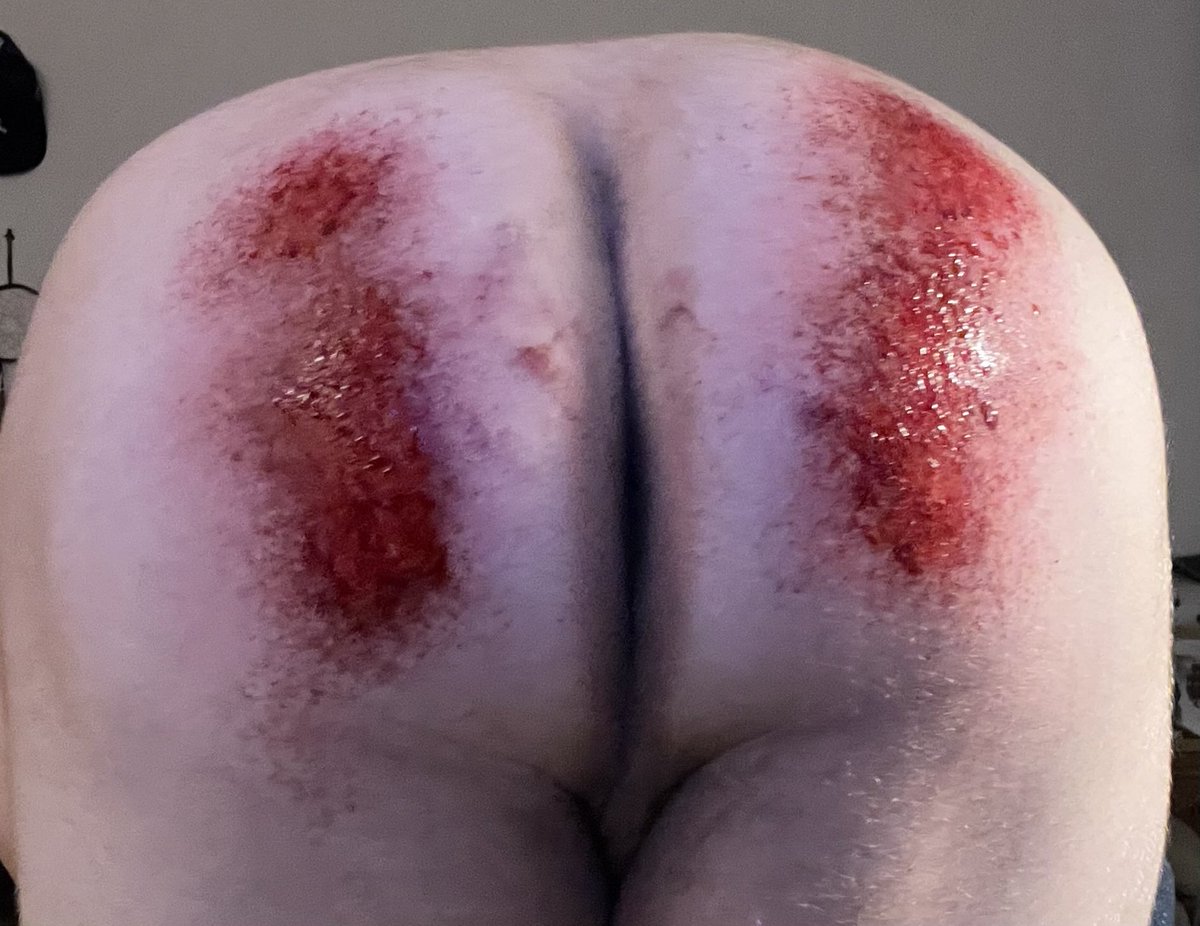 spankingforyou's tweet photo. Bloody spanking giving reviving spankings for free just DM https://t.co/lKjtdwjVxA