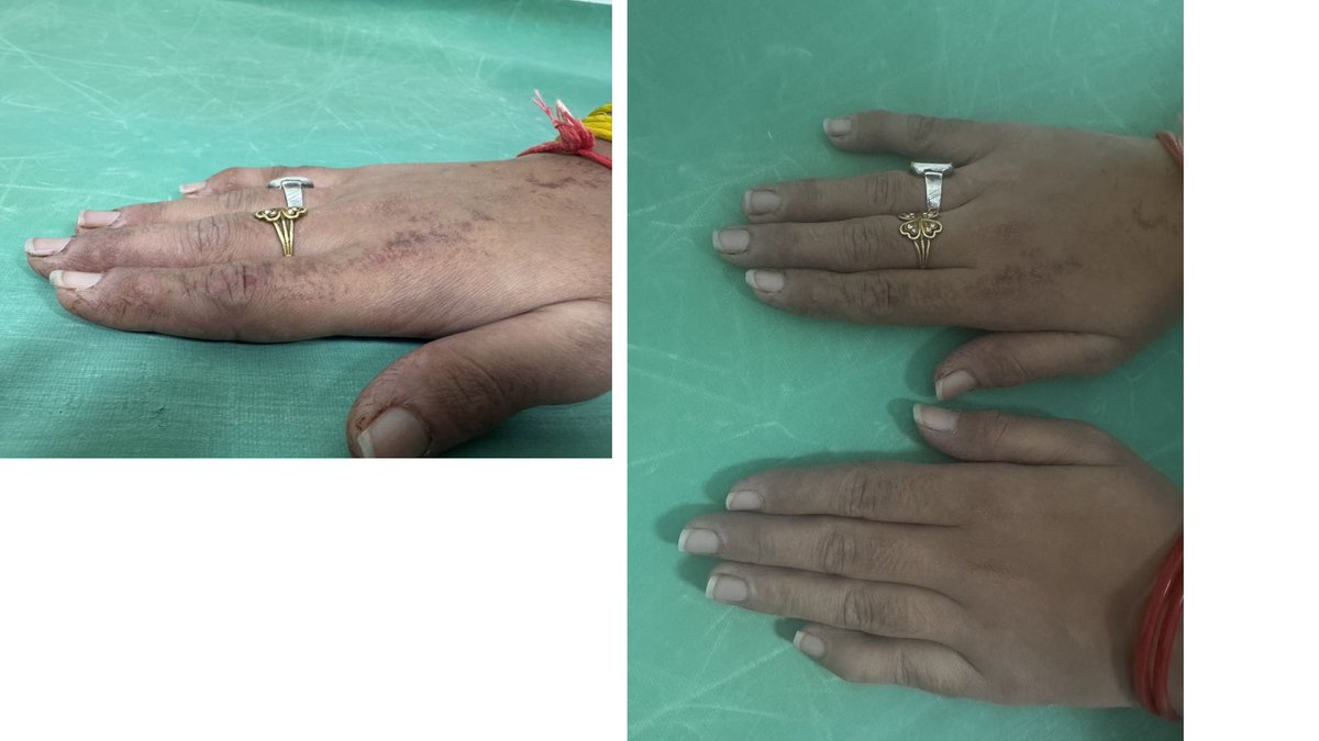 Abhilasha21822's tweet photo. SLE or myositis? 

Can you tell just by looking at the hands?🙄 https://t.co/1zmXJZDwZT