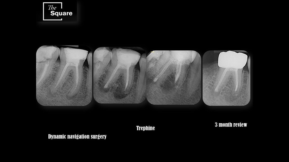 VyROnSq's tweet photo. Dynamic navigation surgery 46 under robot Eva from #navident and 3 months healing https://t.co/iud4EQhASa