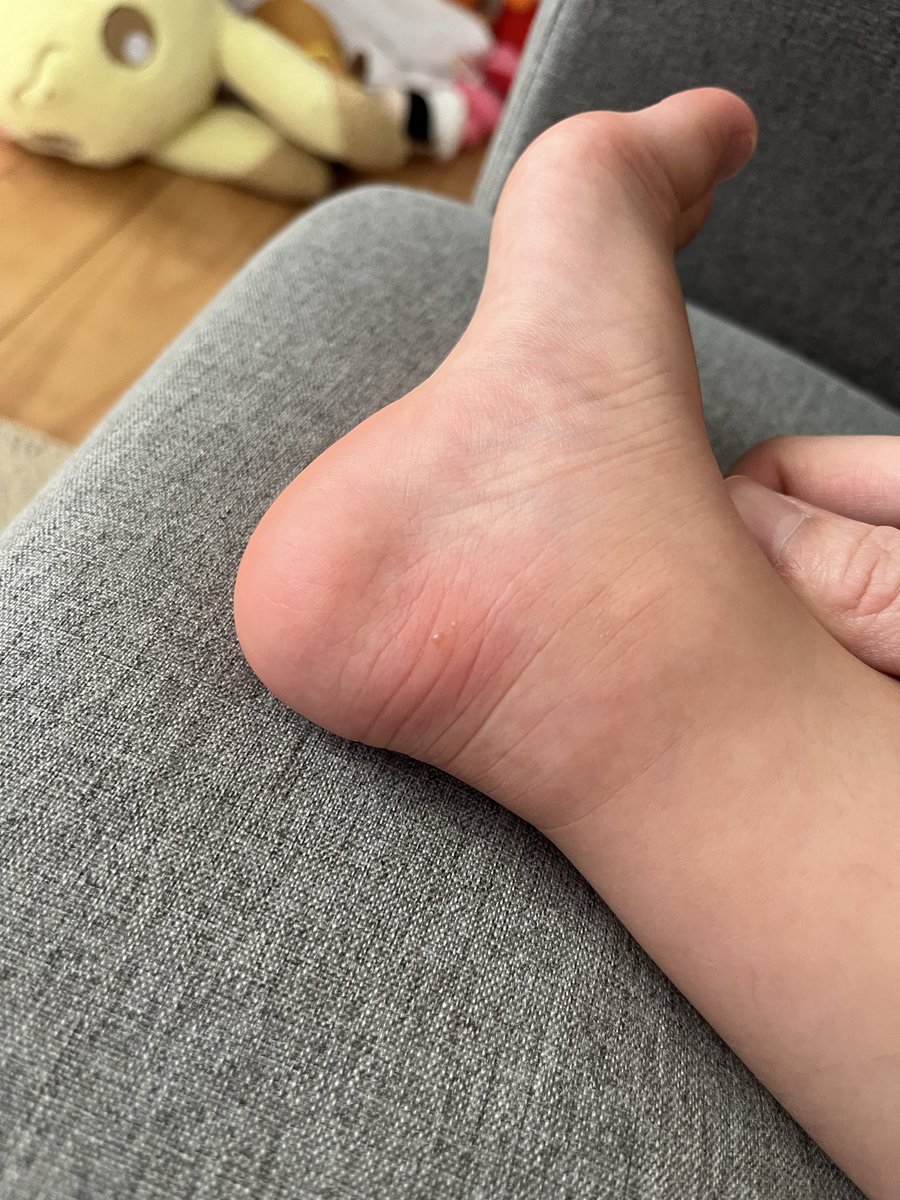 niconicoich__'s tweet photo. これ何か分かる人いませんか？😭

今日のお昼に1個見つけて夕方にもう1個出てきて...痛いらしい 💦 https://t.co/E87UJOKGRa