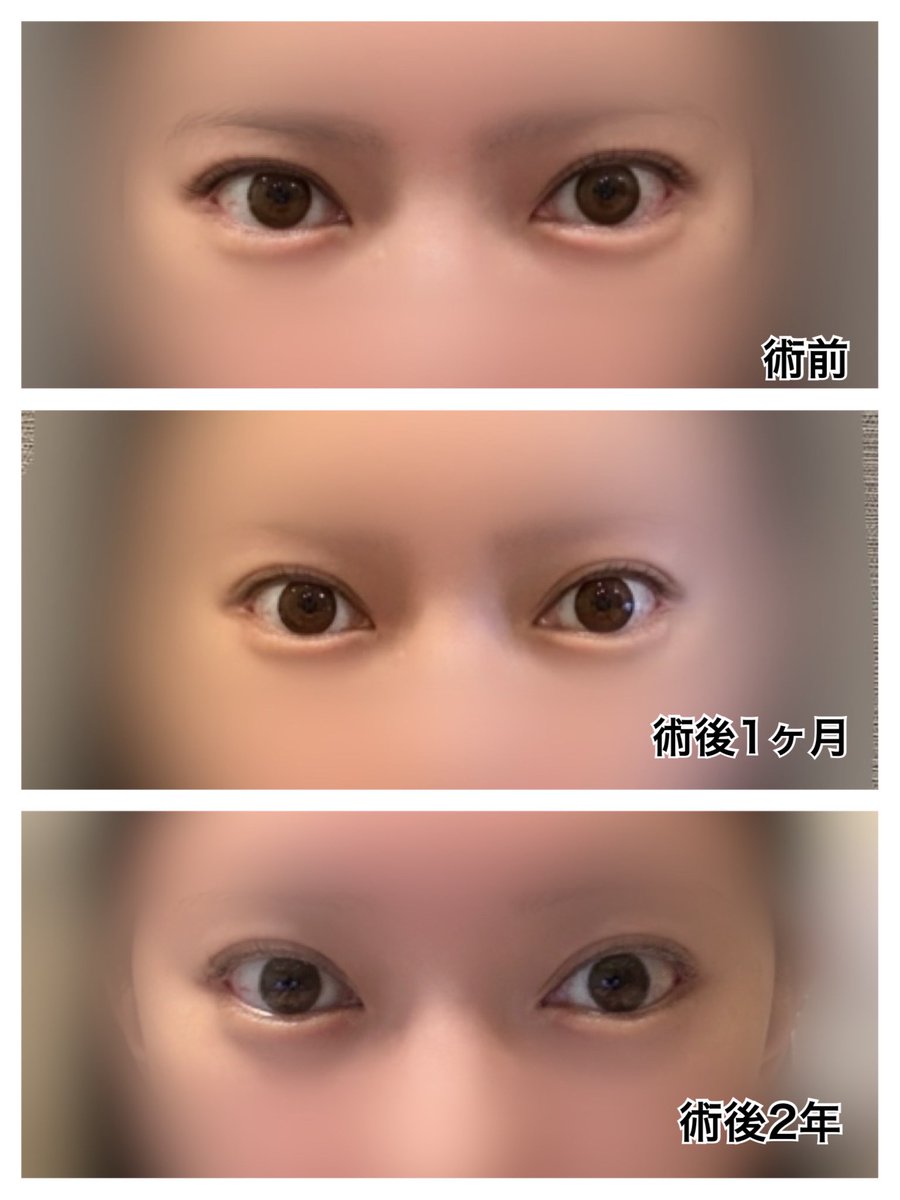 h4t2ud's tweet photo. 額挙上やってからもうすぐ2年だけどやっぱめっちゃやってよかった(๑˃̵ᴗ˂̵)いまだに傷口ゾワゾワするけどw後戻り全然してないし私みたいな瞼ダルダル民にはおすすめ https://t.co/TdH0vh59Gb