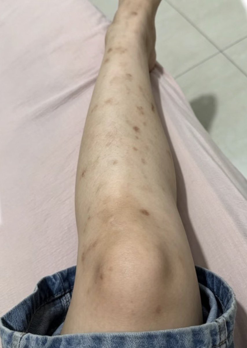 lostdr4ft's tweet photo. Rajin bodycare buat hilangin bekas gigitan serangga, hiperpigmentasi dan bekas luka https://t.co/NVqlX9sGSo