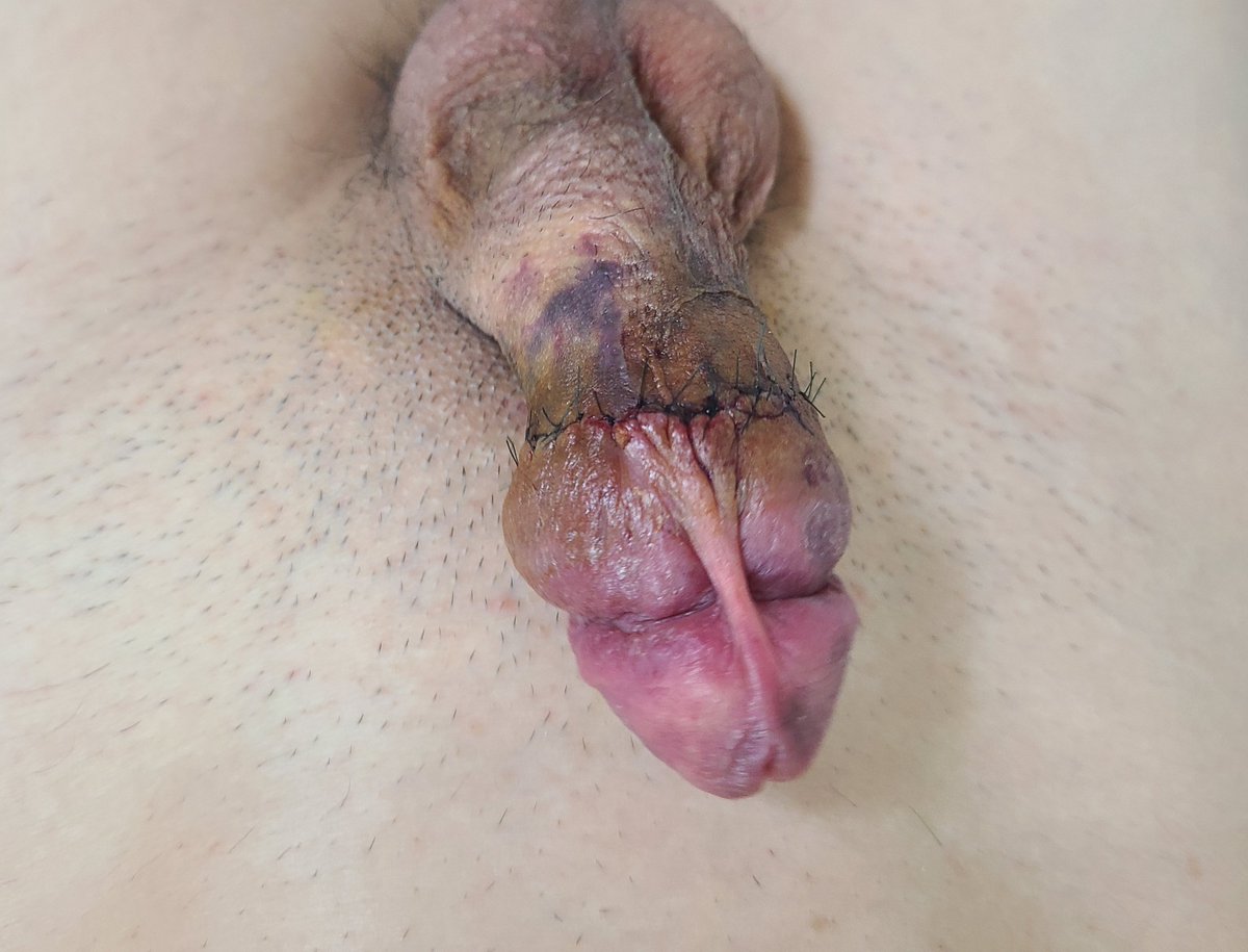 skytree0012's tweet photo. 포경 재수술 3일차

내포피 붓기가 심해짐

#포경수술 #Circumcision #Circumsexual #teamcut https://t.co/4Ml6IAPSNI