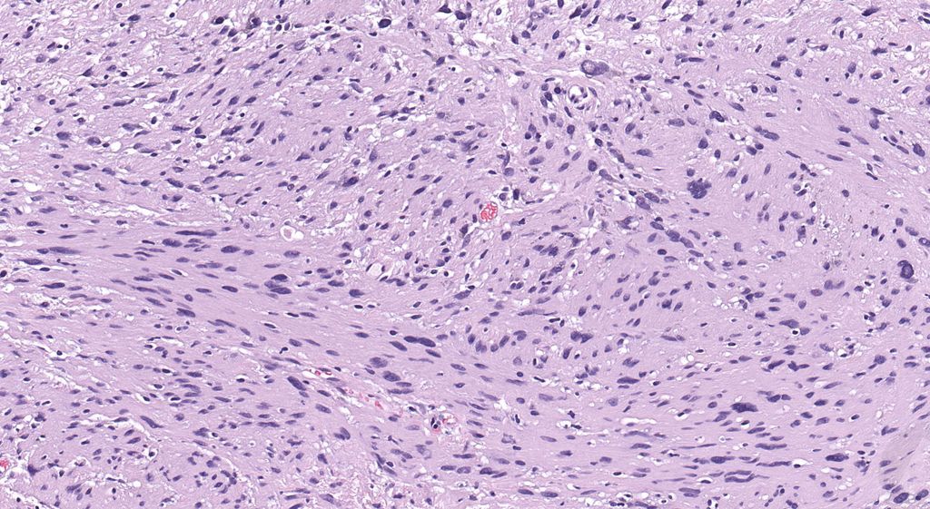JMGardnerMD's tweet photo. 35 yo woman with 4 cm popliteal mass. Your diagnosis? 
Answer ✅  https://t.co/fJVUgseqgK 
Digital slide 🔬 https://t.co/OCtBu3Y8HH 
More info: https://t.co/L5VlQ2jIBq 
#pathology #pathologists #pathTwitter #dermpath #dermatology #dermtwitter #BSTpath https://t.co/92kZz0r0as